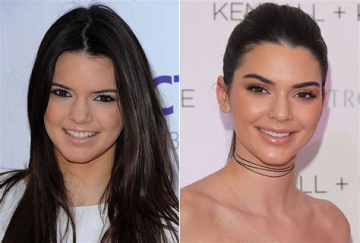 Kendall Jenner before and after